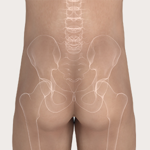Steg 1 for applisering av Mepilex Border Sacrum
