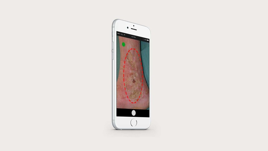 application d'imagerie montrant un ulcère du pied diabétique